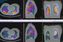 Lung V Q Scan SPECT-CT +ve.jpg