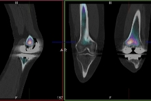 Antigranulocyte Scan Website.jpg